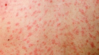 दादुराका ६७ बिरामी उपचारपछि घर फर्के, २० जनाको ‘आइसोलेसन’ उपचार जारी