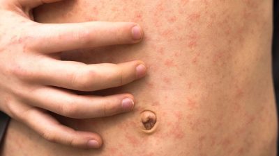 ढोरपाटनमा फैलिएको दादुरा अझै नियन्त्रणमा आएन