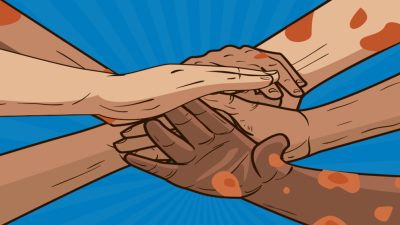 चितवनमा १८ जनामा कुष्ठरोगको सङ्क्रमण